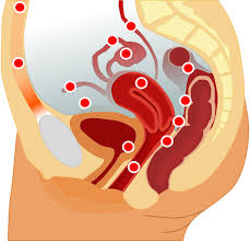 endometriozis-elofordulasa-a-testben Endometriózis előfordulása a testben